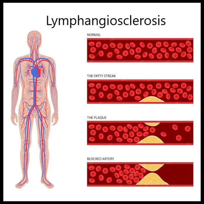 Lymphangiosclerosis